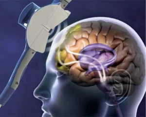 Transcranial-Magnetic-Stimulation-(tms)-Therapy